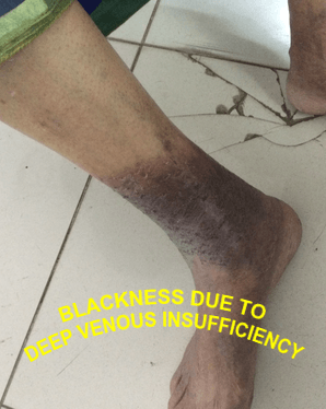 venous INSUFFICIENCY  for shoes DEEP VENOUS insufficiency